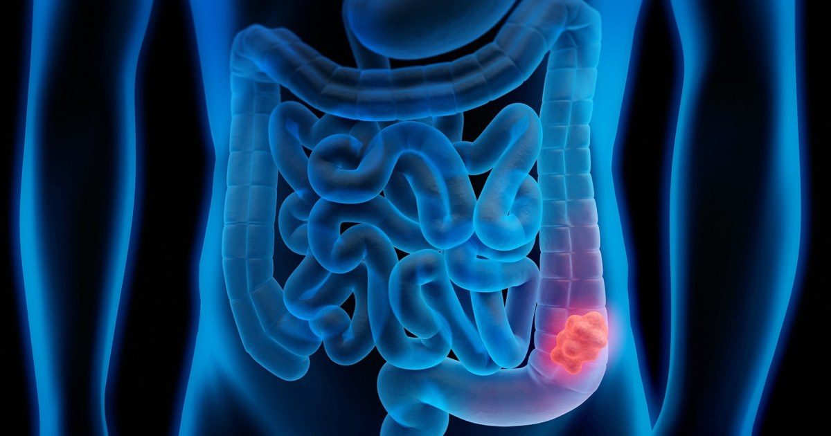 Study Reveals Promising Results in Fight Against Colon Cancer